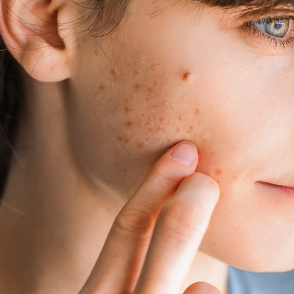 Ichthammol Ointment 9.8% 30 mL